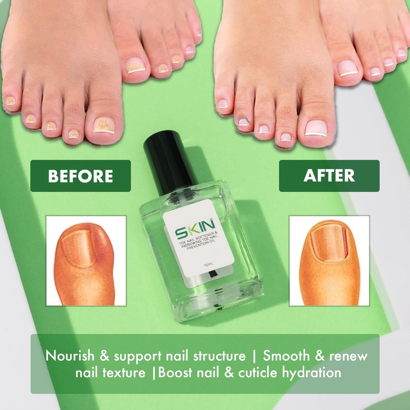 Skinapeel Toenail Softener & Ingrowing Toenail Prevention Oil  Free UK Delivery